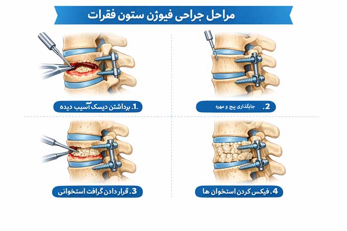 مراحل جراحی فیوژن ستون فقرات