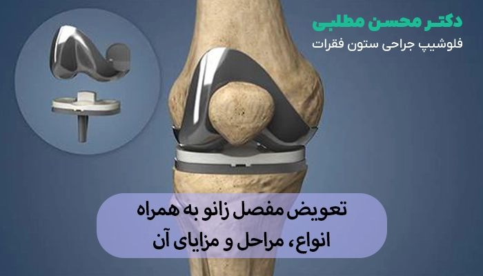 تعویض مفصل زانو به همراه انواع، مراحل و مزایای آن
