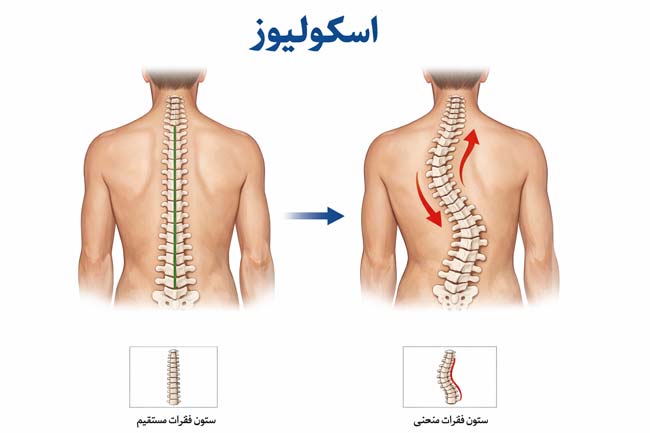 اسکولیوز چیست