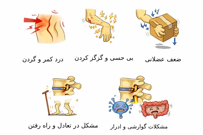 علائم تنگی کانال نخاعی