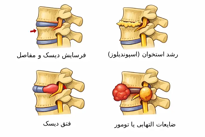علت تنگی کانال نخاعی