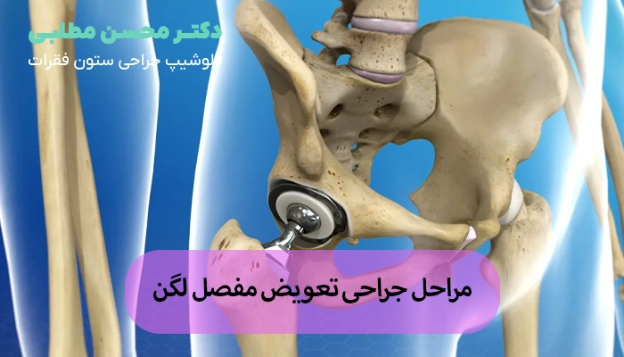 مراحل جراحی تعویض مفصل لگن