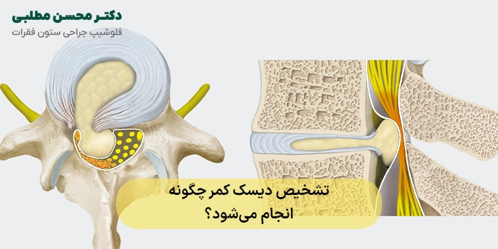تشخیص دیسک کمر چگونه انجام میشود؟