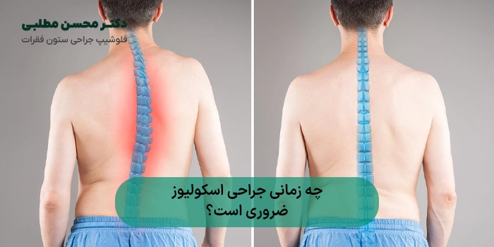 چه زمانی جراحی اسکولیوز ضروری است؟