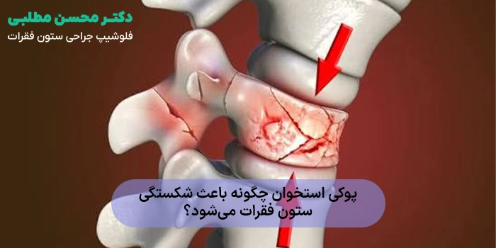 پوکی استخوان چگونه باعث شکستگی ستون فقرات میشود؟