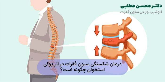 درمان شکستگی ستون فقرات در اثر پوکی استخوان چگونه است؟